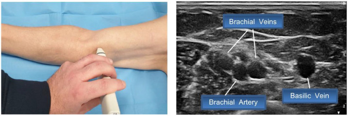The SIP protocol update: Eight strategies, incorporating Rapid Peripheral Vein Assessment (RaPeVA), to minimize complications associated with peripherally inserted central catheter insertion.