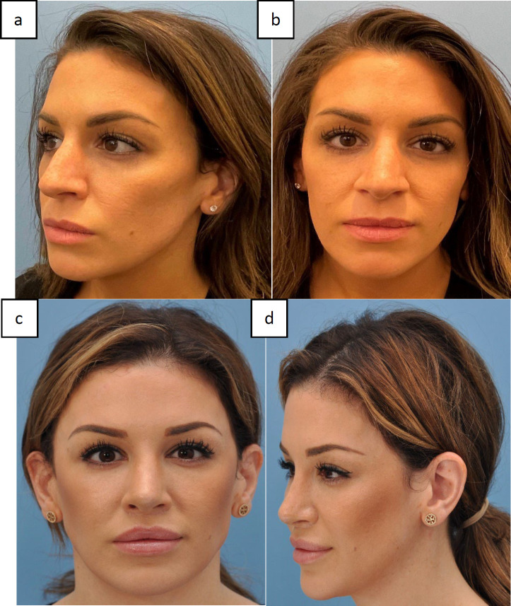 The Safety and Outcomes of Simultaneous Open Rhinoplasty, Alar Reduction, and Upper Lip-Lift through One Surgery.