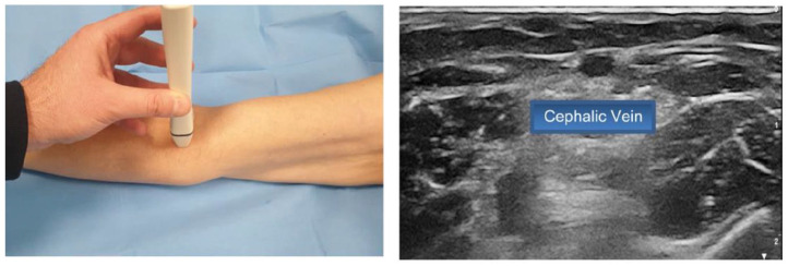 The SIP protocol update: Eight strategies, incorporating Rapid Peripheral Vein Assessment (RaPeVA), to minimize complications associated with peripherally inserted central catheter insertion.