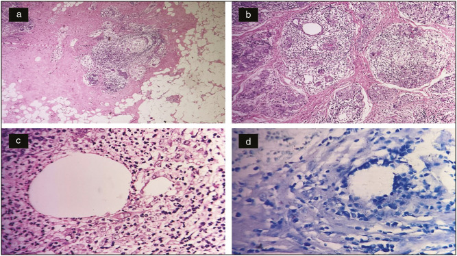Cystic Neutrophilic Granulomatous Mastitis: A Cytological Evaluation.
