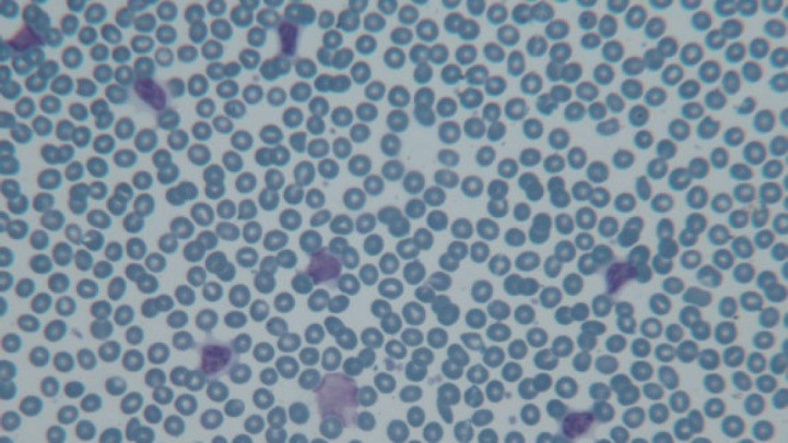 Evaluation of the Findings of Peripheral Blood Smear, Bone Marrow Aspiration and Biopsy, Iron Storage, and Immunophenotype in Patients with Chronic Lymphocytic Leukemia.