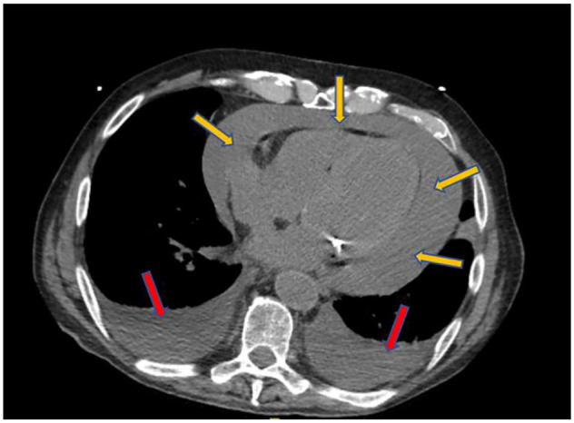 An Odd Presentation of Dysphagia Due to Pericardial Effusion.