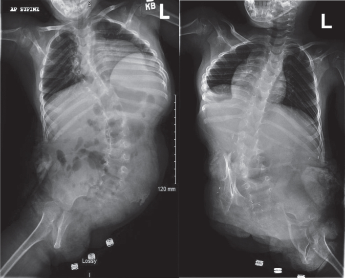 Rehabilitation and functional outcomes for thoraco-omphalo-ischiopagus conjoined twins five years after separation: A case report.
