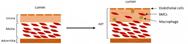 Association between small dense low-density lipoprotein and carotid intima-media thickness.