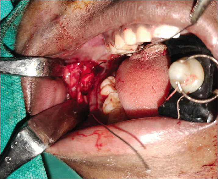 A Novel Method to Fix Paediatric Mandibular Fracture using 2-0 Polyglactin Suture: A Technical Note.