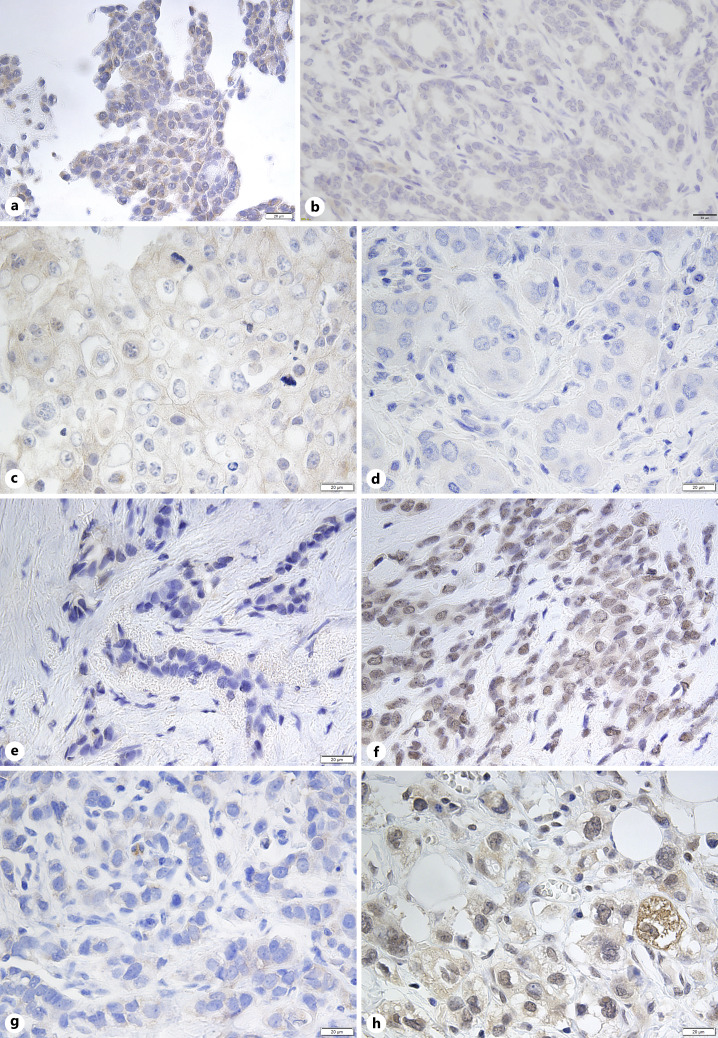 Cytomorphological Disparities in Invasive Breast Cancer Cells following Neoadjuvant Endocrine Therapy and Chemotherapy.