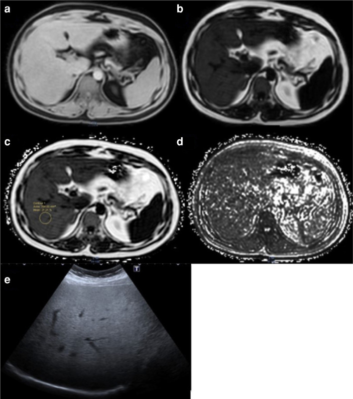 Correlation between ultrasonography and MR proton density fat fraction techniques in evaluating the severity of liver steatosis.