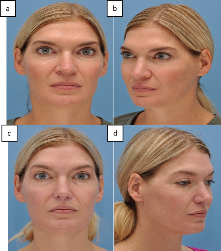 The Safety and Outcomes of Simultaneous Open Rhinoplasty, Alar Reduction, and Upper Lip-Lift through One Surgery.