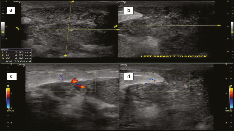 Cystic Neutrophilic Granulomatous Mastitis: A Cytological Evaluation.