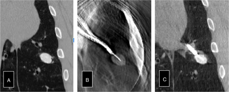 "Tool-in-lesion" Accuracy of Galaxy System-A Robotic Electromagnetic Navigation BroncHoscopy With Integrated Tool-in-lesion-Tomosynthesis Technology: The MATCH Study.
