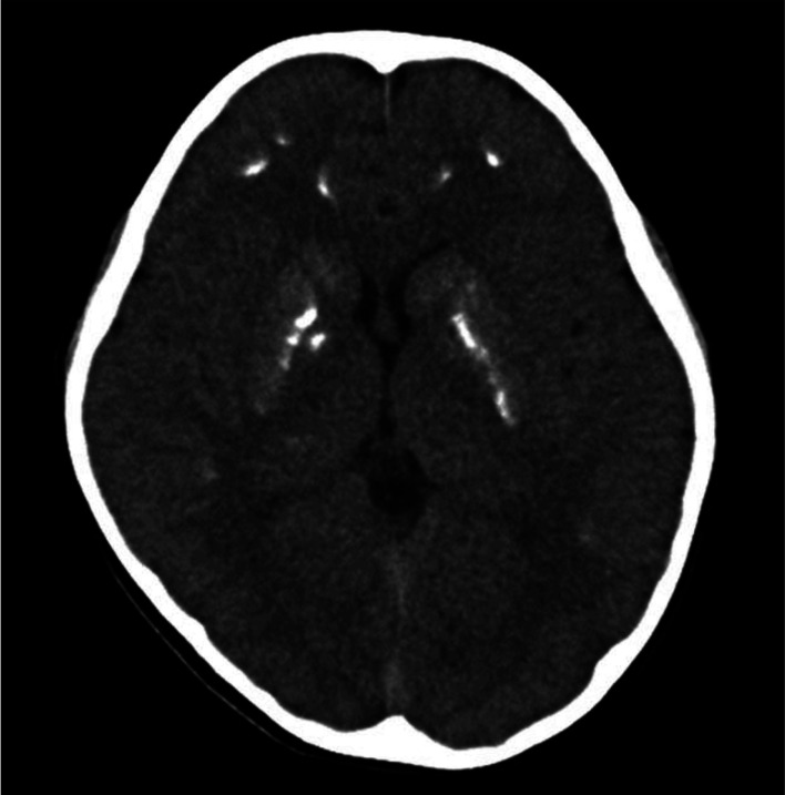 Pseudohypoparathyroidism type 1B with involuntary movements: a case report and literature review.