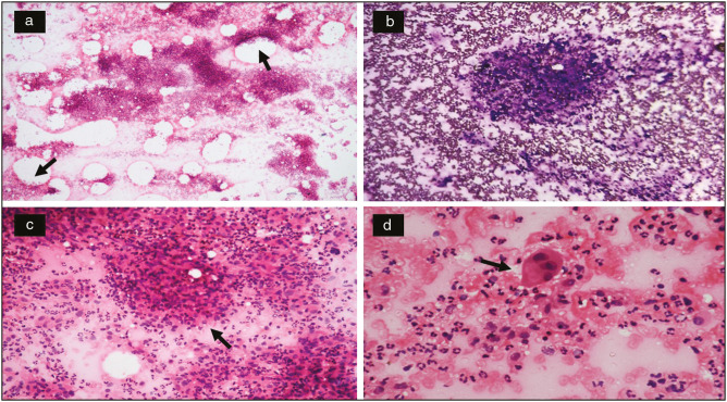 Cystic Neutrophilic Granulomatous Mastitis: A Cytological Evaluation.