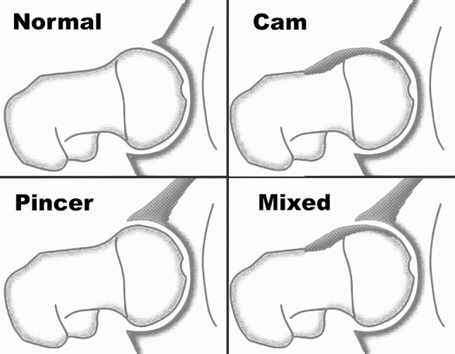 How to start with hip arthroscopy in a safe and effective manner, using an evidence-based approach.