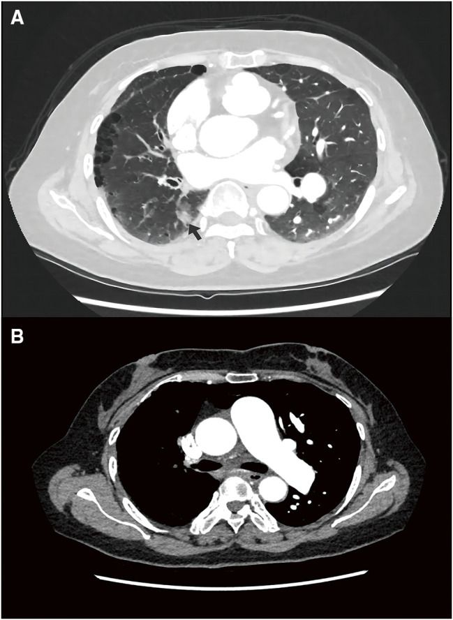 Thoracoscopic Sublobectomy for Lung Cancer in a Patient with Unilateral Absence of Pulmonary Artery: Case Report and Narrative Review.