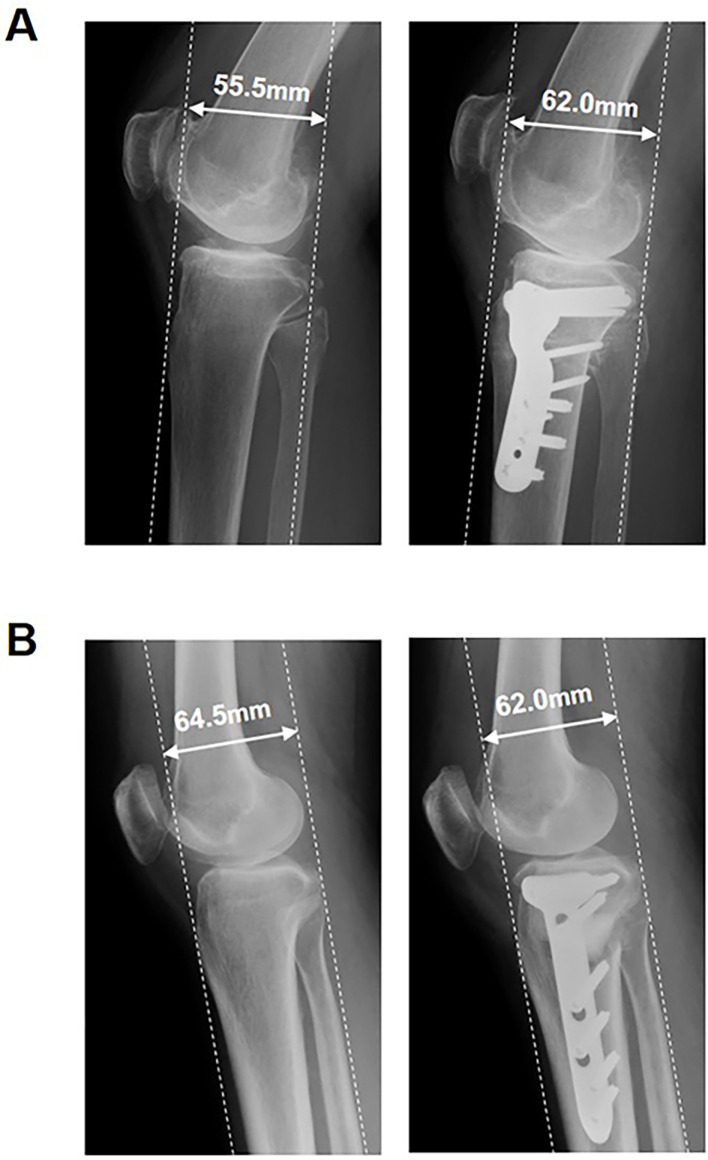 Difference in the anterior displacement of the tibial tuberosity relative to the proximal tibial fragment between opening wedge and closed wedge high tibial osteotomies.