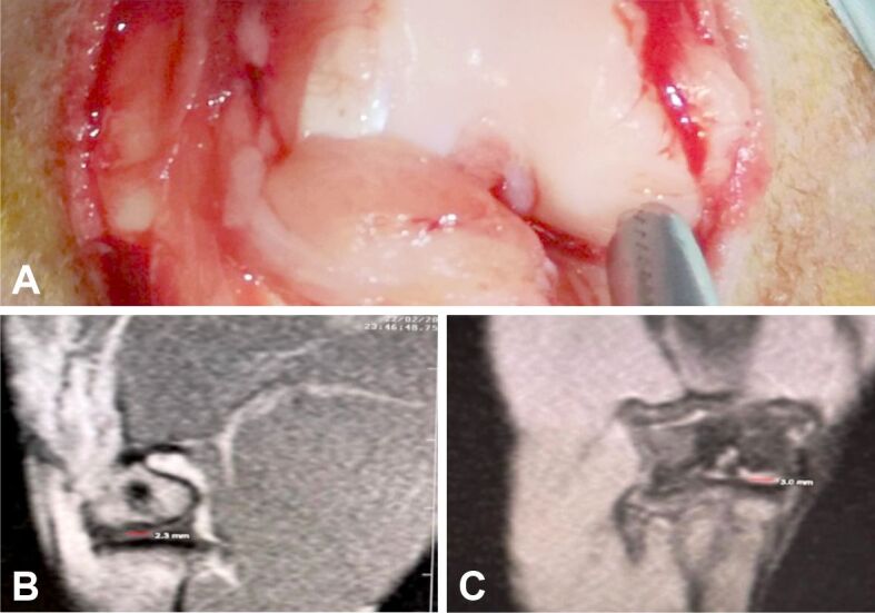 Magnetic resonance imaging combined with histological evaluation of repair process using the microfracture technique in an association of osteocartilaginous and meniscal surgically induced lesions of the knee. In vivo experiment on a rabbit model.