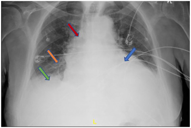An Odd Presentation of Dysphagia Due to Pericardial Effusion.