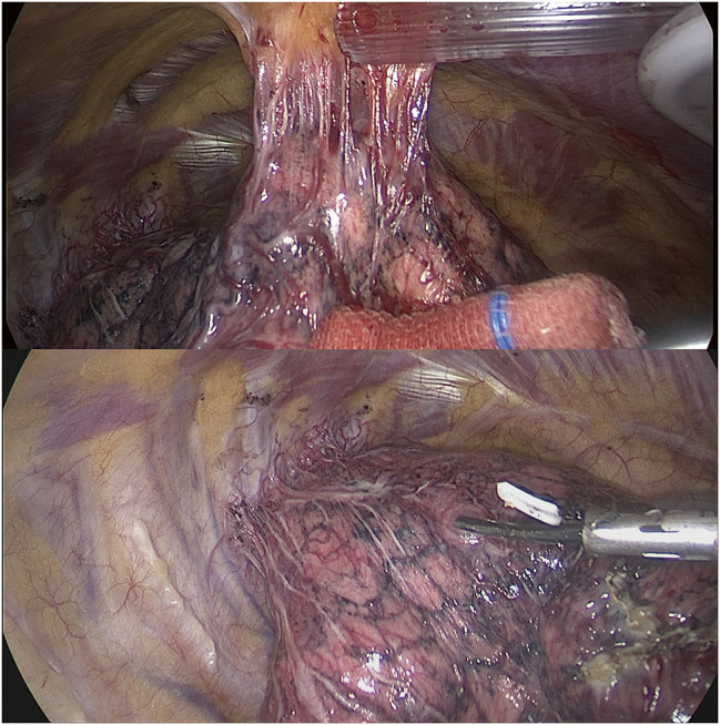 Thoracoscopic Sublobectomy for Lung Cancer in a Patient with Unilateral Absence of Pulmonary Artery: Case Report and Narrative Review.