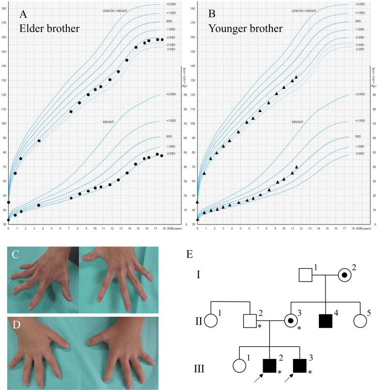 A novel missense variant of <i>FGD1</i> disrupts critical cysteine residues of the FYVE domain in Japanese siblings with Aarskog-Scott syndrome.