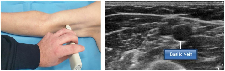 The SIP protocol update: Eight strategies, incorporating Rapid Peripheral Vein Assessment (RaPeVA), to minimize complications associated with peripherally inserted central catheter insertion.