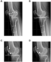 Difference in the anterior displacement of the tibial tuberosity relative to the proximal tibial fragment between opening wedge and closed wedge high tibial osteotomies.