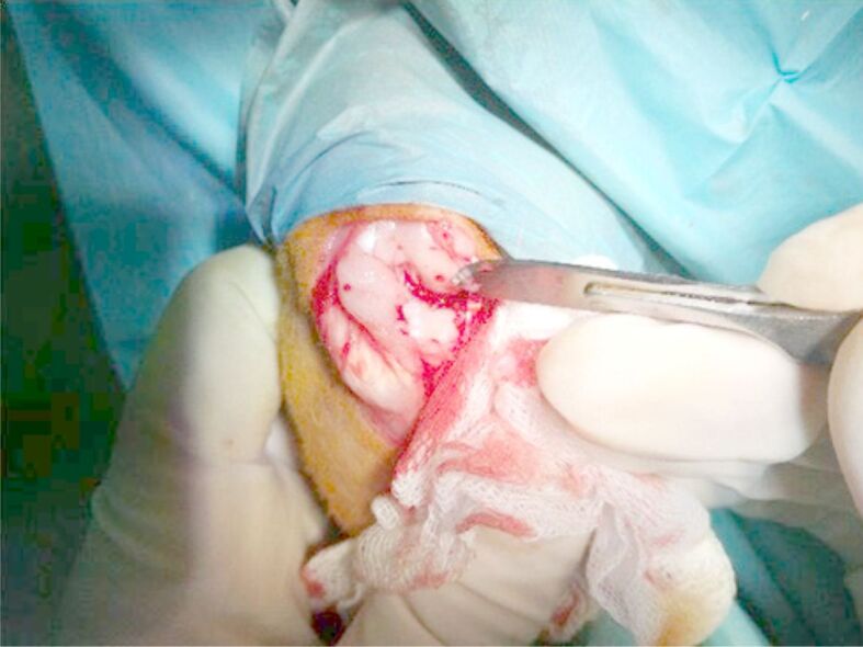 Magnetic resonance imaging combined with histological evaluation of repair process using the microfracture technique in an association of osteocartilaginous and meniscal surgically induced lesions of the knee. In vivo experiment on a rabbit model.