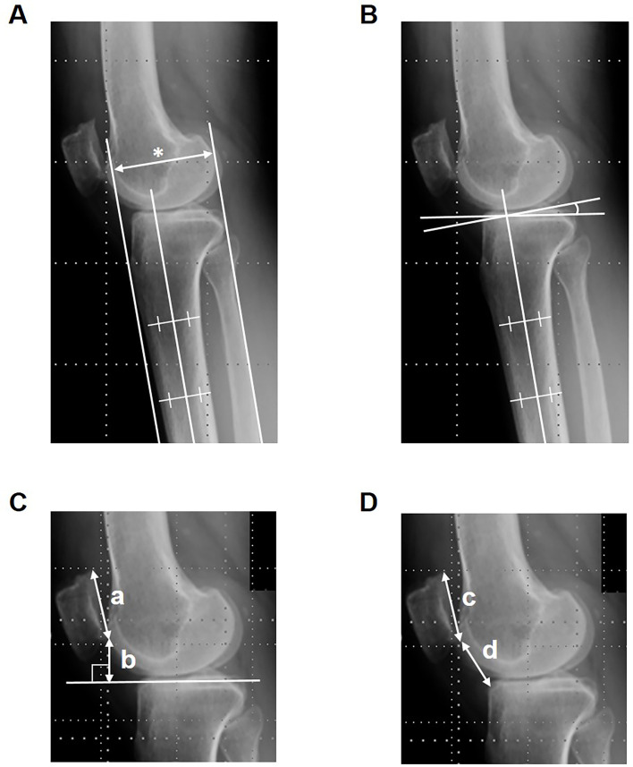Difference in the anterior displacement of the tibial tuberosity relative to the proximal tibial fragment between opening wedge and closed wedge high tibial osteotomies.