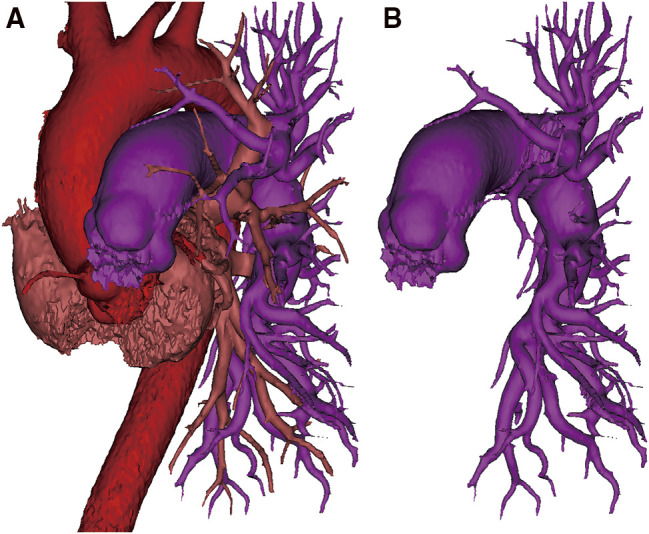 Thoracoscopic Sublobectomy for Lung Cancer in a Patient with Unilateral Absence of Pulmonary Artery: Case Report and Narrative Review.