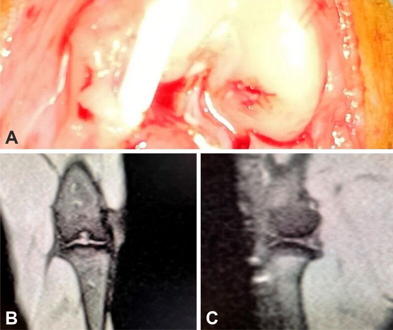 Magnetic resonance imaging combined with histological evaluation of repair process using the microfracture technique in an association of osteocartilaginous and meniscal surgically induced lesions of the knee. In vivo experiment on a rabbit model.