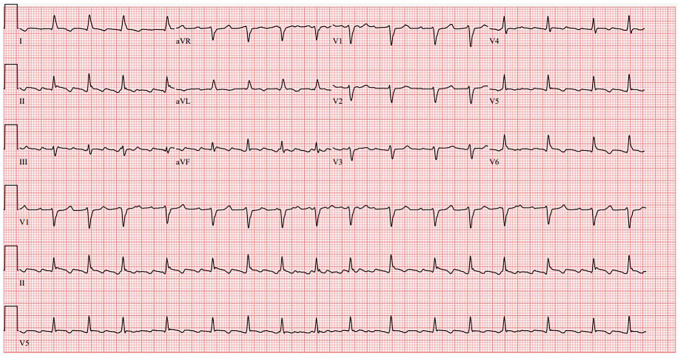 An Odd Presentation of Dysphagia Due to Pericardial Effusion.