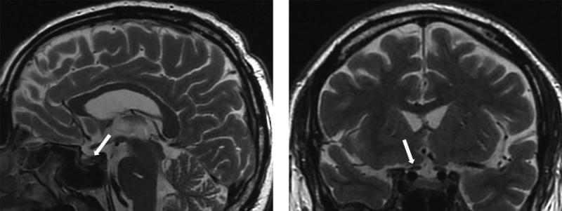 [Differential diagnosis and tactics of managing a patient with primary hypophysitis on the example of a clinical case].