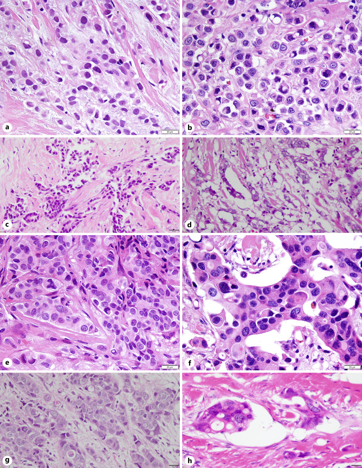 Cytomorphological Disparities in Invasive Breast Cancer Cells following Neoadjuvant Endocrine Therapy and Chemotherapy.