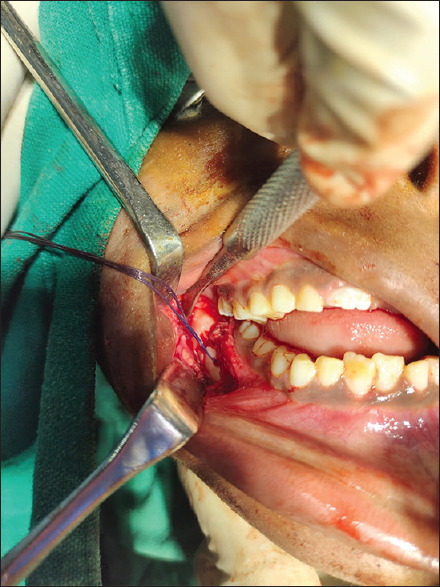 A Novel Method to Fix Paediatric Mandibular Fracture using 2-0 Polyglactin Suture: A Technical Note.
