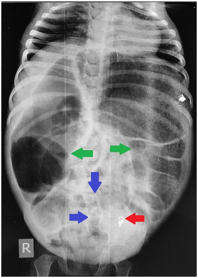 Delayed presentation of congenital sigmoid colon stenosis: a rare entity.