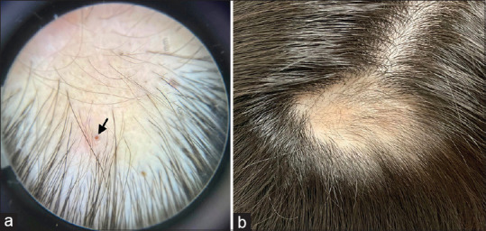 Alopecic Scalp Cysts Following Isotretinoin.