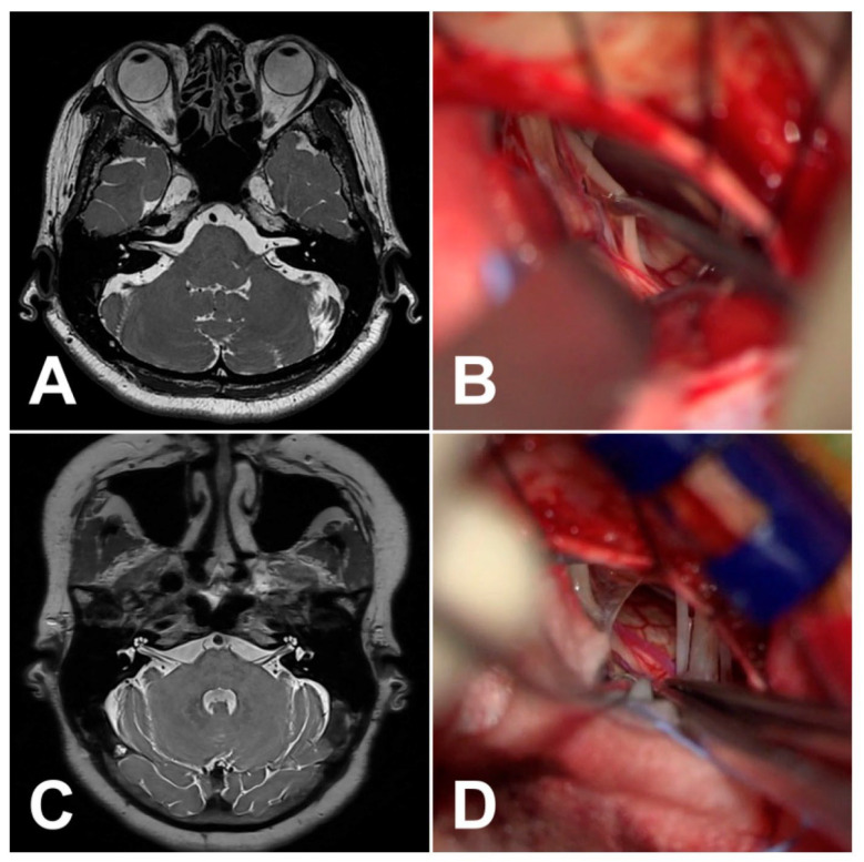 Treatment Challenges in Hemifacial Spasm: The Role of Magnetic Resonance Imaging.