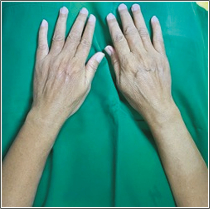 Evaluation of Wrinkle and Dermal Thickness in the Forearm before and after Picosecond Laser Therapy.
