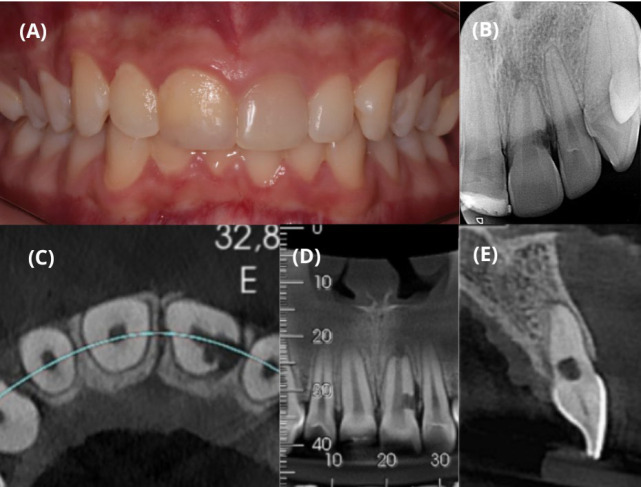Treatment of Invasive Cervical Resorption in a Central Incisor by Intentional Replantation: A Case Report.