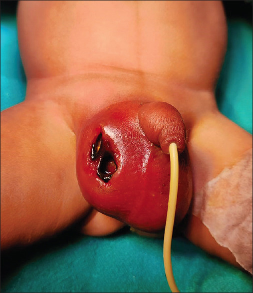 Advocating for Routine Post-natal Surveillance and Urgent Neonatal Inguinal Hernia Repair.