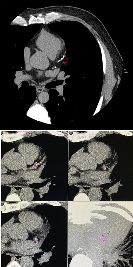 Coronary artery calcium score percentiles: data from a single center in Turkey.