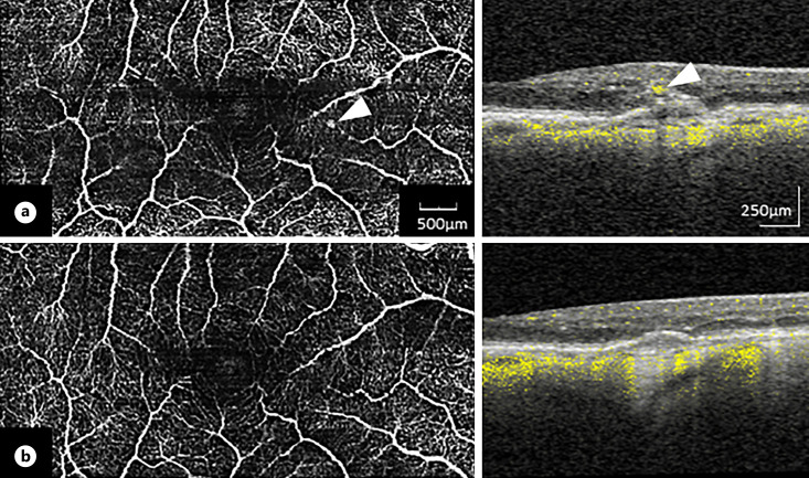 Current Perspectives on Type 3 Macular Neovascularization due to Age-Related Macular Degeneration.