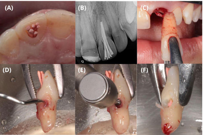 Treatment of Invasive Cervical Resorption in a Central Incisor by Intentional Replantation: A Case Report.