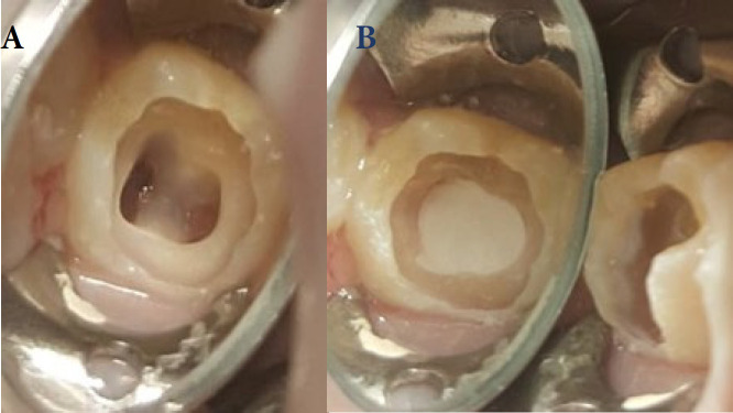 Comparative Outcomes of Pulpotomy in Mature Molars with Irreversible Pulpitis: A Non-Randomized Trial Evaluating Calcified and Non-Calcified Pulp Chambers.