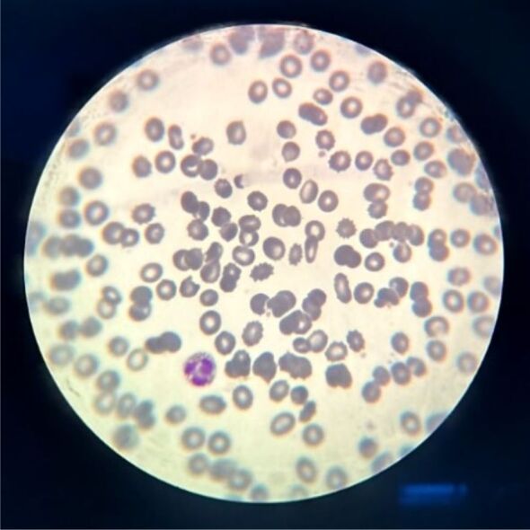 The influence of sepsis on erythrocytes morphology: case report and literature review.