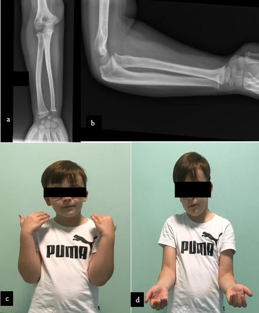 Pediatric Floating Elbow: Case Report and Review of the Literature.