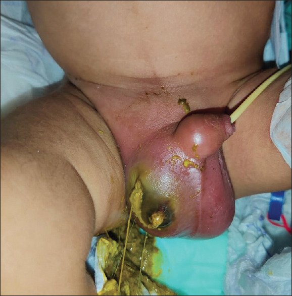 Advocating for Routine Post-natal Surveillance and Urgent Neonatal Inguinal Hernia Repair.