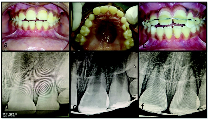 Management of Laryngoscope-Induced Iatrogenic Dental Injury: A Case Series.