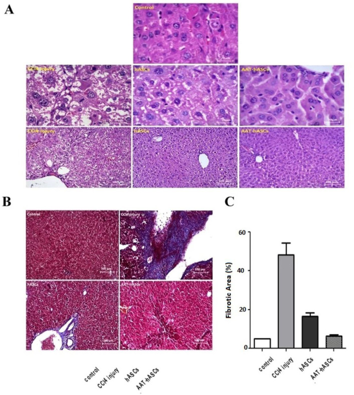 Effectiveness of human adipose tissue-derived mesenchymal stem cells expressing alpha-1 antitrypsin gene in liver fibrosis: a study in mice.