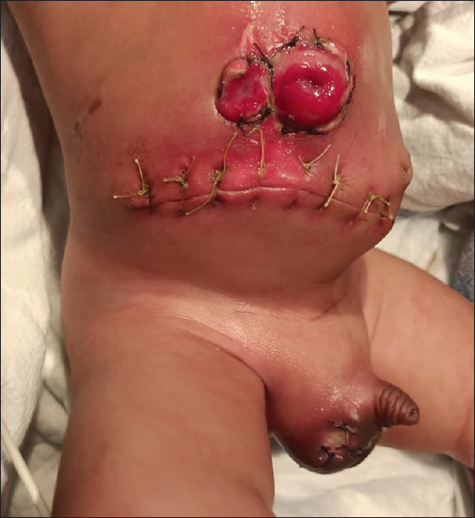 Advocating for Routine Post-natal Surveillance and Urgent Neonatal Inguinal Hernia Repair.