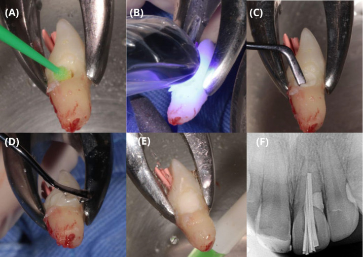Treatment of Invasive Cervical Resorption in a Central Incisor by Intentional Replantation: A Case Report.